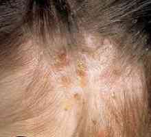 Uši v laseh: zdravljenje in fotografija bolezni