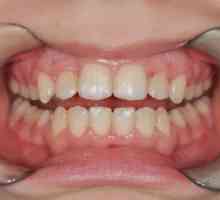Izenačevanje zob pri odraslih in otrocih brez opor