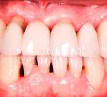Bolezen dlesni: vrste, opis, simptomi in zdravljenje
