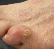 Bolezni stopal stopal: kako pozdraviti suhe kaluse