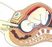 Kakšna je potreba po prebadanju mehurja pred porodom