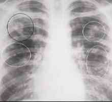 Je tuberkulom pljuč in kakšne so posledice?