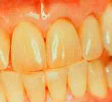 Rumeni zobje: vzroki, metode beljenja, preprečevanje