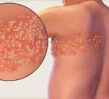 Seznanitev z herpes zoster: simptomi in zdravljenje