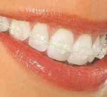 Sistem zobnega nosilca: značilnosti sistemov in njihova namestitev