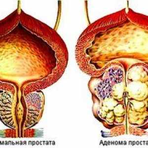 Adenoma prostate: zdravljenje z ljudskimi zdravili
