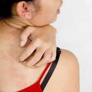 Berber alergija: simptomi, zdravljenje, križni proizvodi