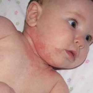 Alergije pri novorojenčkih in dojenčkih