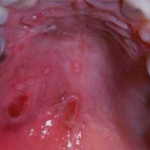 V ustih bolečine: vzroki in zdravljenje
