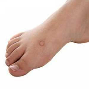 Bradavice na nogah: foto formacije na stopalih in njihovo zdravljenje