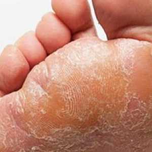 Preden se zdravimo z glivicami stopal: pripravki kemikalije in nacionalni agenti