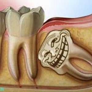 Kaj storiti, če zobje modrosti raste in dlesni boli