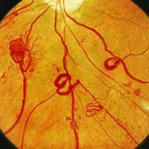 Kaj je diabetična retinopatija: faze, simptomi in zdravljenje