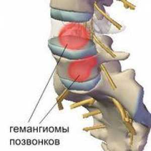 Kaj je to - hrbtenični hemangiom, načini zdravljenja