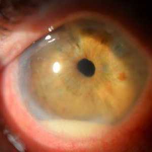 Kaj je to bolezen očesne bolezni iridociklitis?