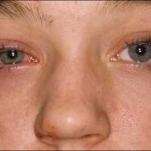 Kaj je to - keratitis očesa: simptomi, fotografije in zdravljenje