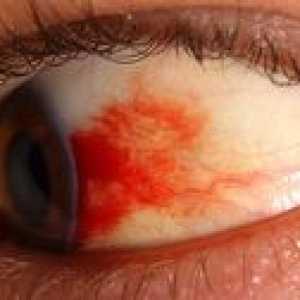 Kakšna je to retinopatija očesa: vrste, simptomi in zdravljenje