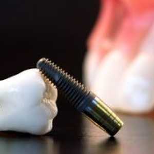 Kaj je zobna implantacija zob: vrste in opis