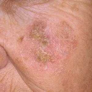 Kaj je keratoza in kakšne so razlike te bolezni?