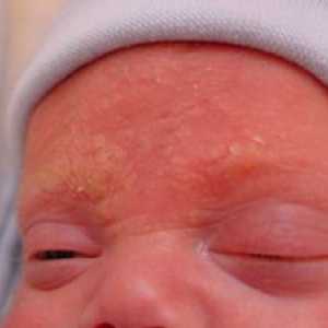 Kaj je seboreični dermatitis pri dojenčkih?