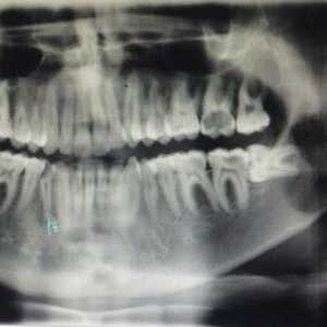 Kaj je zob zoba v zobozdravstvu?