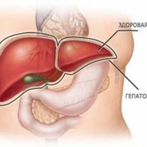 Hepatomegalija jeter: kaj je to in kako ga zdraviti
