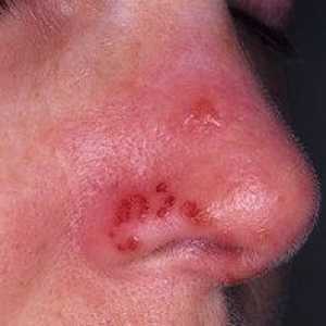 Herpes na nosu: metode za zdravljenje prehladov, fotografija