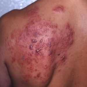 Herpes na telo: opis in fotografija