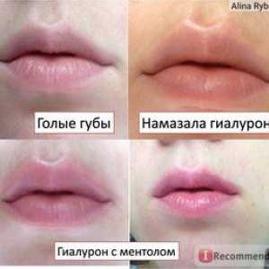 Lip hialuronska kislina: učinki in pregledi