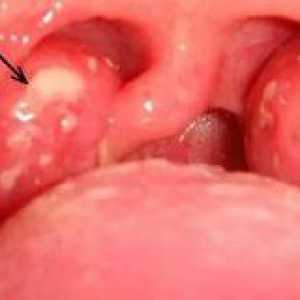 Razjede v grlu brez temperature, kako zdraviti absces?