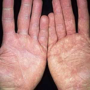 Gobe ​​na prstih: simptomi in fotografija bolezni