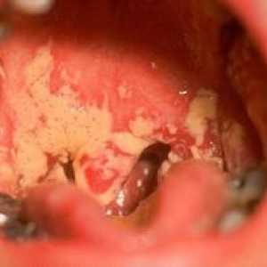 Kako se znebiti drobovja v ustih odraslega?