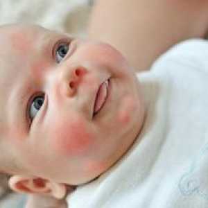 Kako izgleda alergija pri dojenčkih? Vzroki in zdravljenje