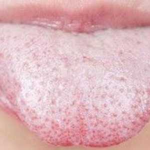 Kandidija ustne votline: zdravljenje ust za odrasle
