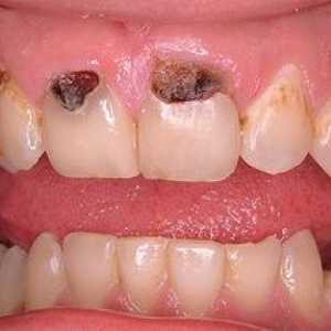 Karies prednjih zob: vzroki in zdravljenje bolezni