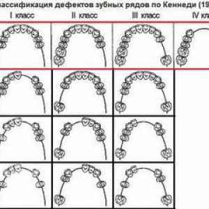 Klasifikacija napak zob v Kennedy in Gavrilov