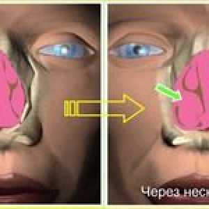 Konhobuloza (hipertrofija nosne conhe): kaj je to?
