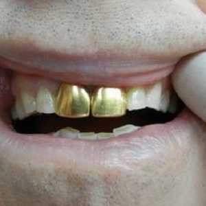 Krone na zobeh: glavne vrste in njihove značilnosti