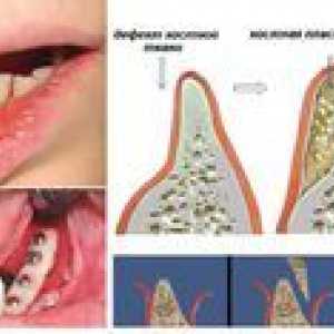 Plastičnost kosti za implantacijo zob: opis in cena