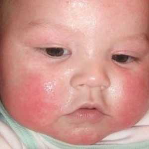Zdravljenje atopičnega dermatitisa pri otrocih s strani zdravniškega komarca