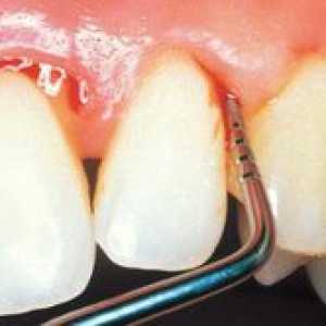 Obdelava gum v zobozdravstvu in morebitne bolezni