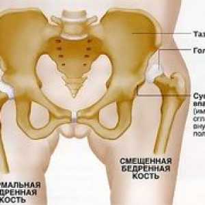 Zdravljenje dislokacije kolčnega sklepa pri odraslih