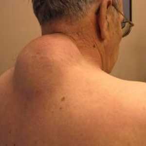 Metode zdravljenja vena na hrbtu in fotografije lipoma