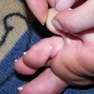 Corns med prsti: vrste in zdravljenje