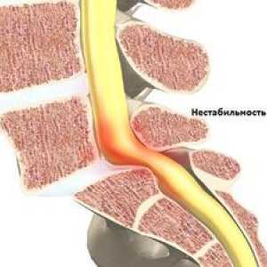 Nestabilnost vratne hrbtenice: zdravljenje in simptomi
