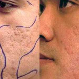 Značilnosti laserske in mehanske dermabrazije obraza