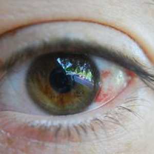 Kaj lahko razbije krvne žile v očeh?