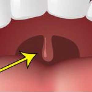 Otekanje palatina v grlu in iz katerega se lahko poveča