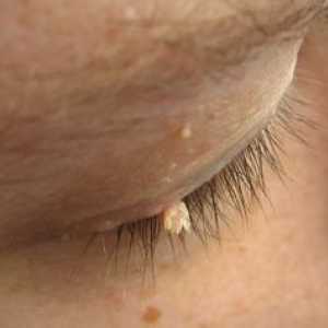 Papillomi na obrazu: značilnosti zdravljenja in fotografije