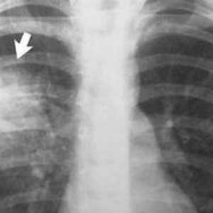 Pljučnica na rentgenskem žarku: znaki bolezni na rentgenskih žarkih